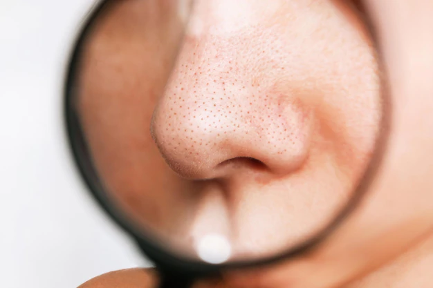 closeup-female-nose-with-blackheads-black-dots-magnifying-glass-white-background_407348-1377