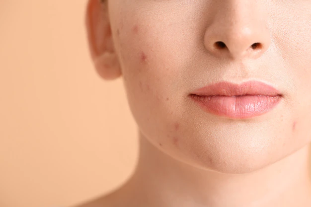 young-woman-with-acne-problem-color_392895-16032
